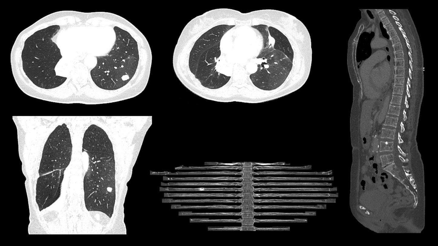 Esempio di immagine oncologica con SOMATOM go.Top